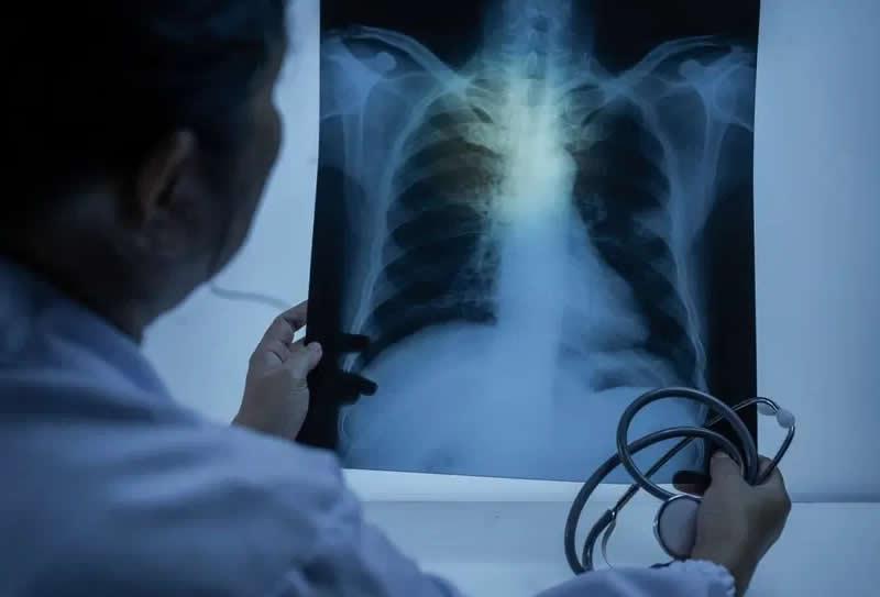 Exames de Imagem que ajudam a diagnosticar doenças pulmonares